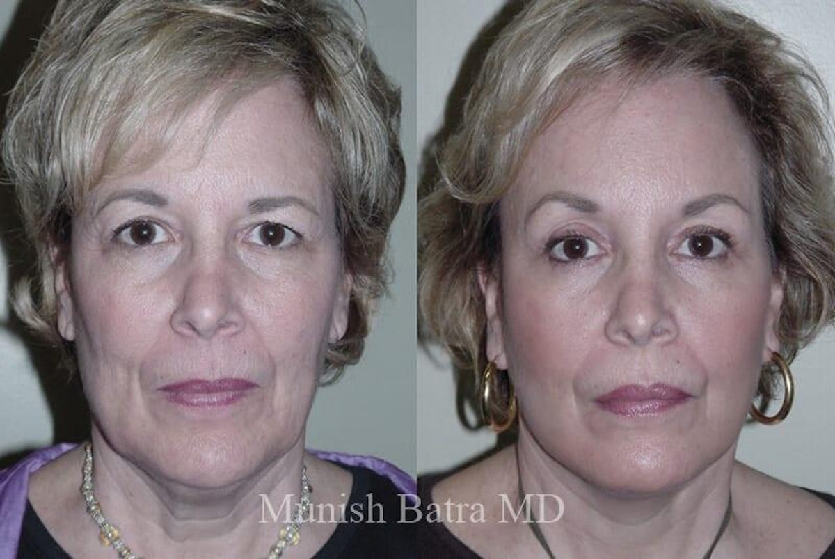 Eyelid Surgery and Brow Lift Before & After Gallery - Patient 334968 - Image 1