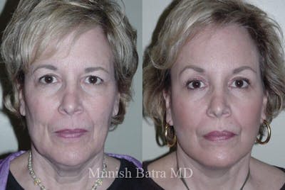 Eyelid Surgery and Brow Lift Before & After Gallery - Patient 334968 - Image 1