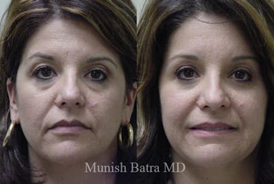 Eyelid Surgery and Brow Lift Before & After Gallery - Patient 272301 - Image 1