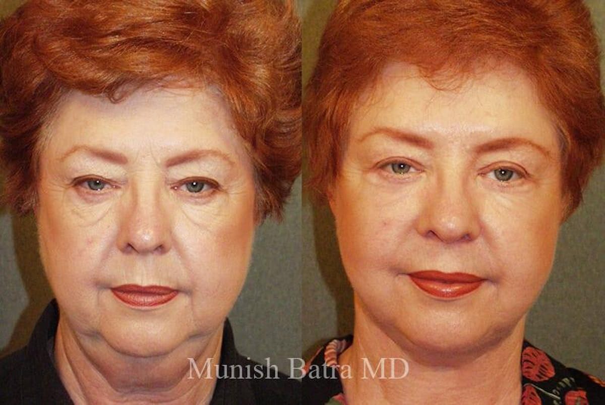 Eyelid Surgery and Brow Lift Before & After Gallery - Patient 311976 - Image 1