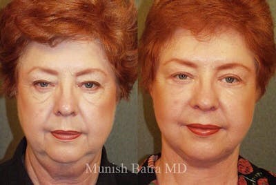 Eyelid Surgery and Brow Lift Before & After Gallery - Patient 311976 - Image 1