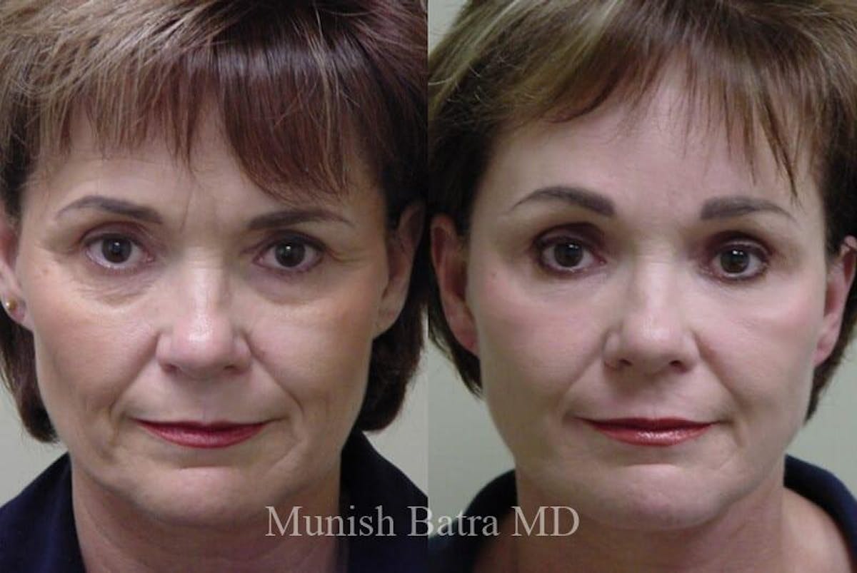 Eyelid Surgery and Brow Lift Before & After Gallery - Patient 424969 - Image 1