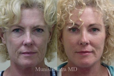 Eyelid Surgery and Brow Lift Before & After Gallery - Patient 972572 - Image 1