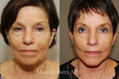 Eyelid Surgery and Brow Lift Before & After Gallery - Patient 105529 - Image 1
