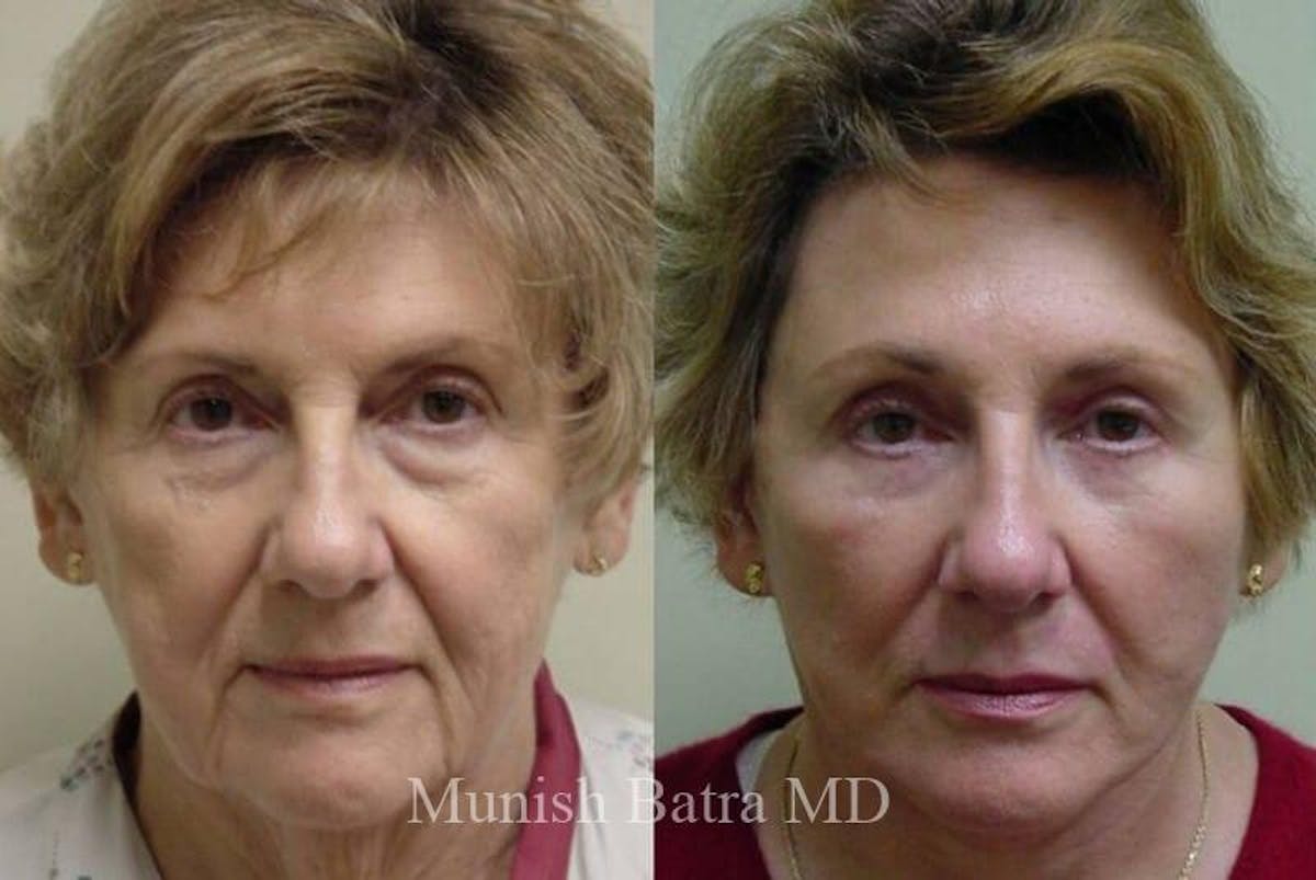 Eyelid Surgery and Brow Lift Before & After Gallery - Patient 180471 - Image 1