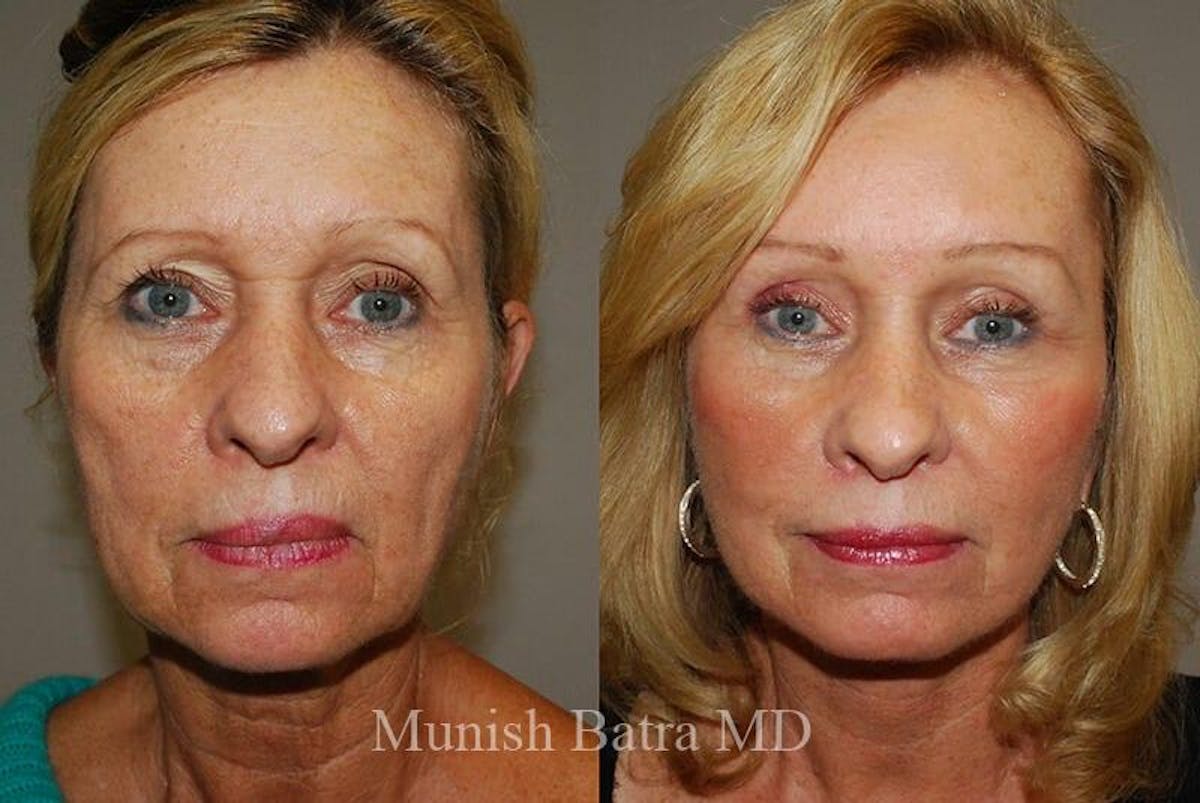 Eyelid Surgery and Brow Lift Before & After Gallery - Patient 123111 - Image 1