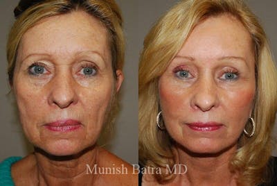 Eyelid Surgery and Brow Lift Before & After Gallery - Patient 123111 - Image 1