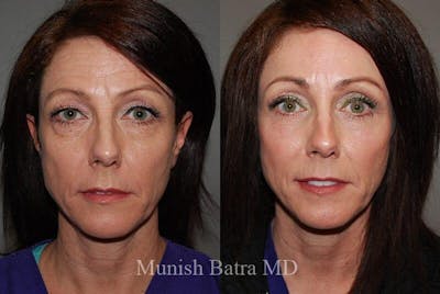 Eyelid Surgery and Brow Lift Before & After Gallery - Patient 387802 - Image 1