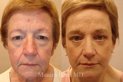 Eyelid Surgery and Brow Lift Before & After Gallery - Patient 606840 - Image 1