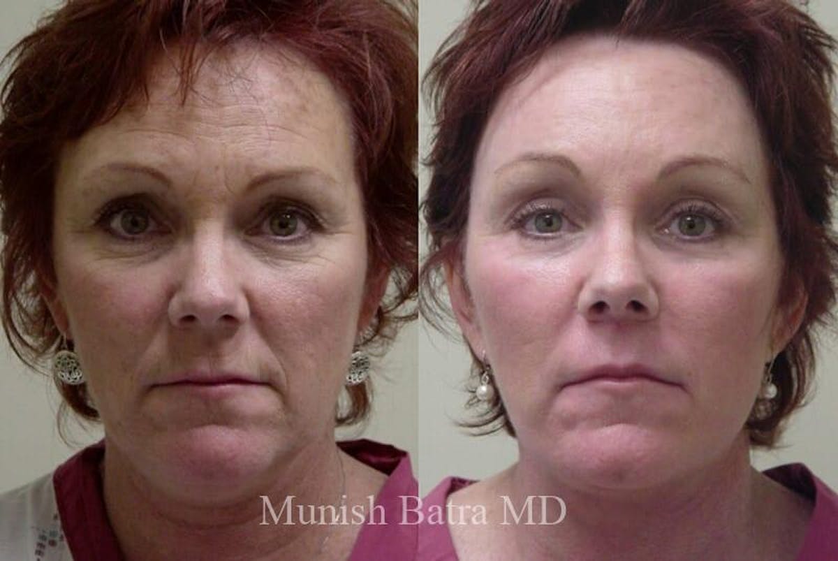 Eyelid Surgery and Brow Lift Before & After Gallery - Patient 444464 - Image 1