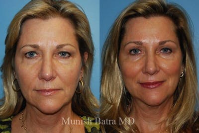 Eyelid Surgery and Brow Lift Before & After Gallery - Patient 406435 - Image 1