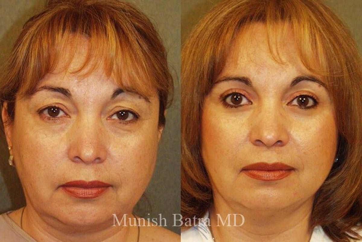 Eyelid Surgery and Brow Lift Before & After Gallery - Patient 387464 - Image 1