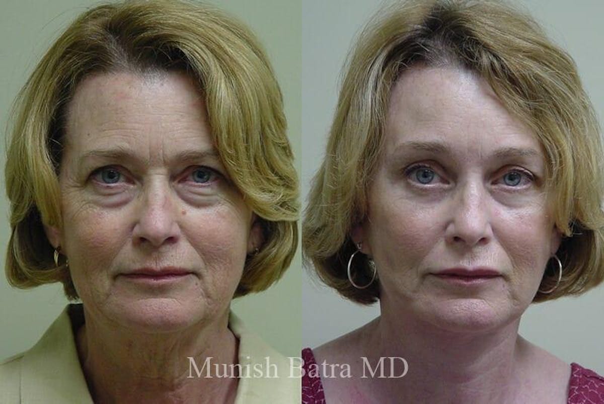 Eyelid Surgery and Brow Lift Before & After Gallery - Patient 167364 - Image 1