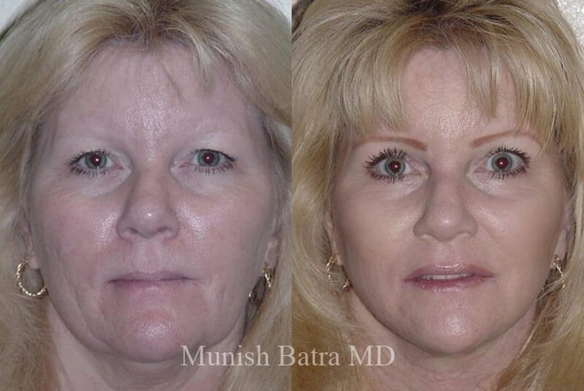 Eyelid Surgery and Brow Lift Before & After Gallery - Patient 446080 - Image 1