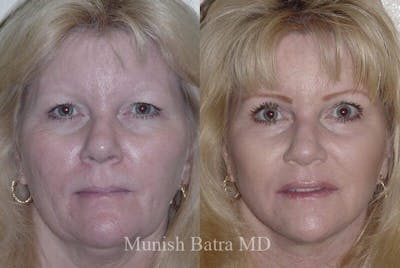 Eyelid Surgery and Brow Lift Before & After Gallery - Patient 446080 - Image 1