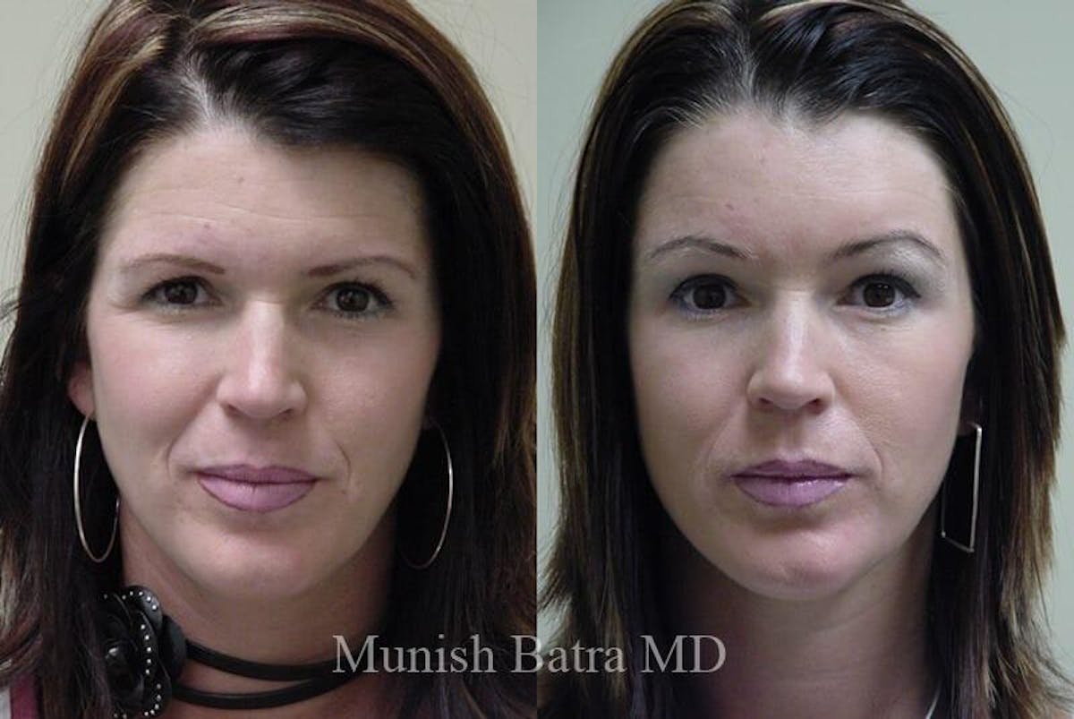 Eyelid Surgery and Brow Lift Before & After Gallery - Patient 370893 - Image 1
