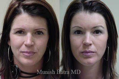 Eyelid Surgery and Brow Lift Before & After Gallery - Patient 370893 - Image 1