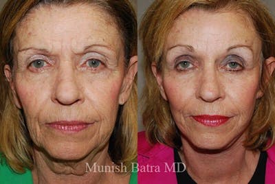 Eyelid Surgery and Brow Lift Before & After Gallery - Patient 104247 - Image 1