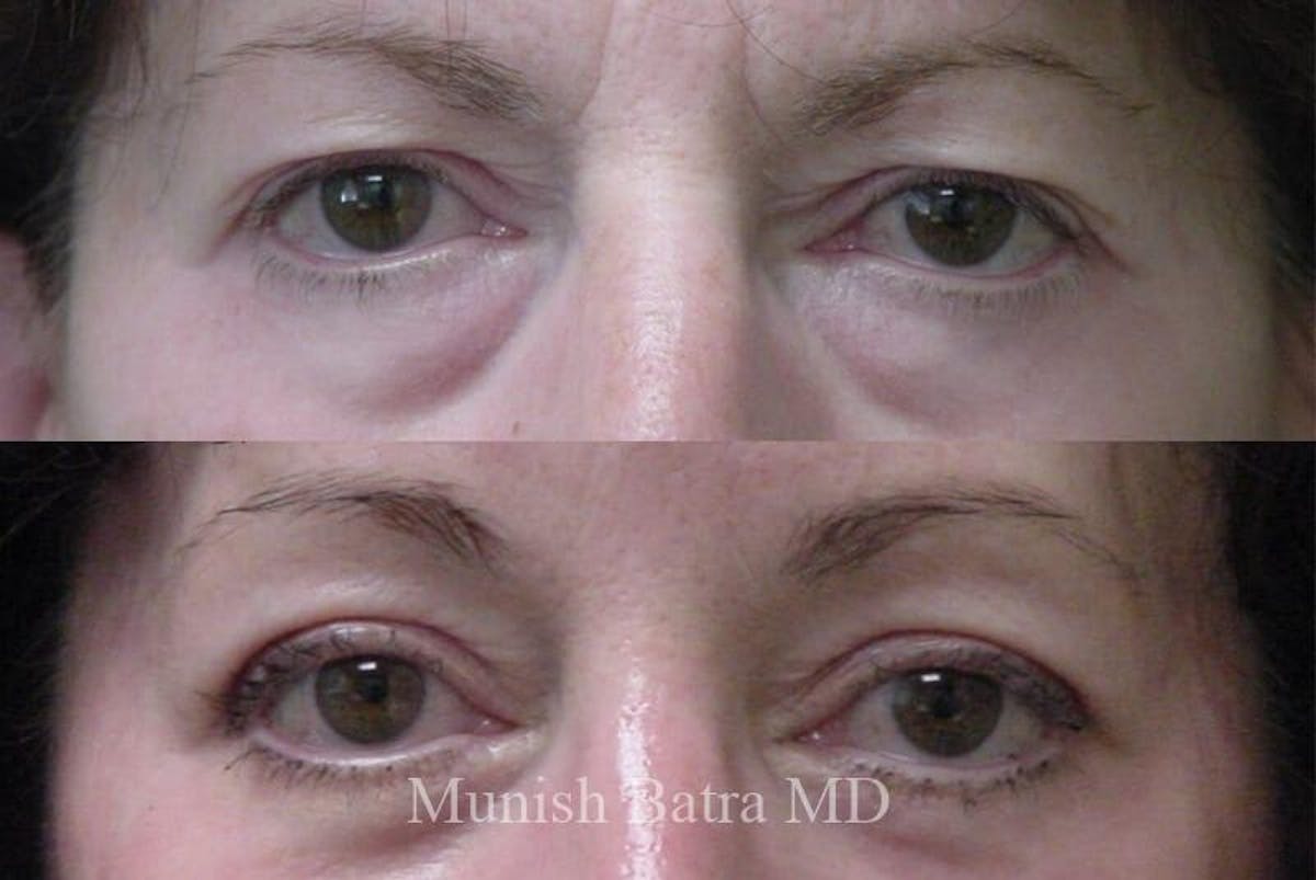 Eyelid Surgery and Brow Lift Before & After Gallery - Patient 515321 - Image 1