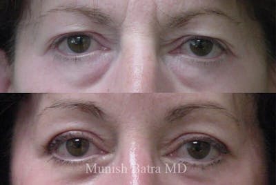 Eyelid Surgery and Brow Lift Before & After Gallery - Patient 515321 - Image 1
