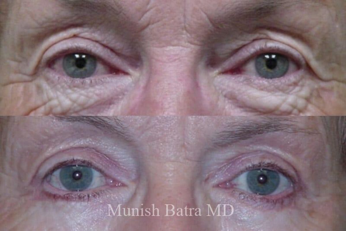 Eyelid Surgery and Brow Lift Before & After Gallery - Patient 410610 - Image 1