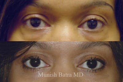Eyelid Surgery and Brow Lift Before & After Gallery - Patient 138811 - Image 1