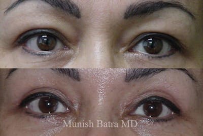 Eyelid Surgery and Brow Lift Before & After Gallery - Patient 409678 - Image 1