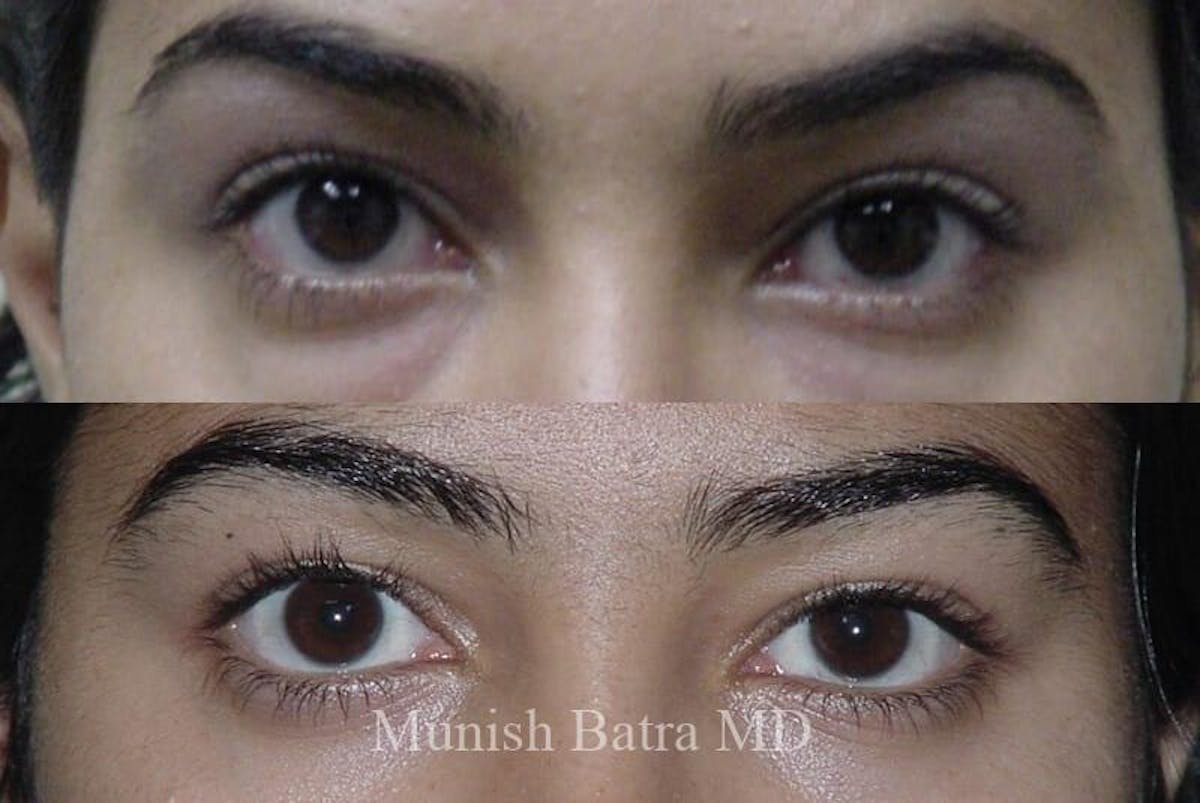 Eyelid Surgery and Brow Lift Before & After Gallery - Patient 159332 - Image 1