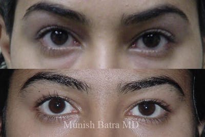 Eyelid Surgery and Brow Lift Before & After Gallery - Patient 159332 - Image 1