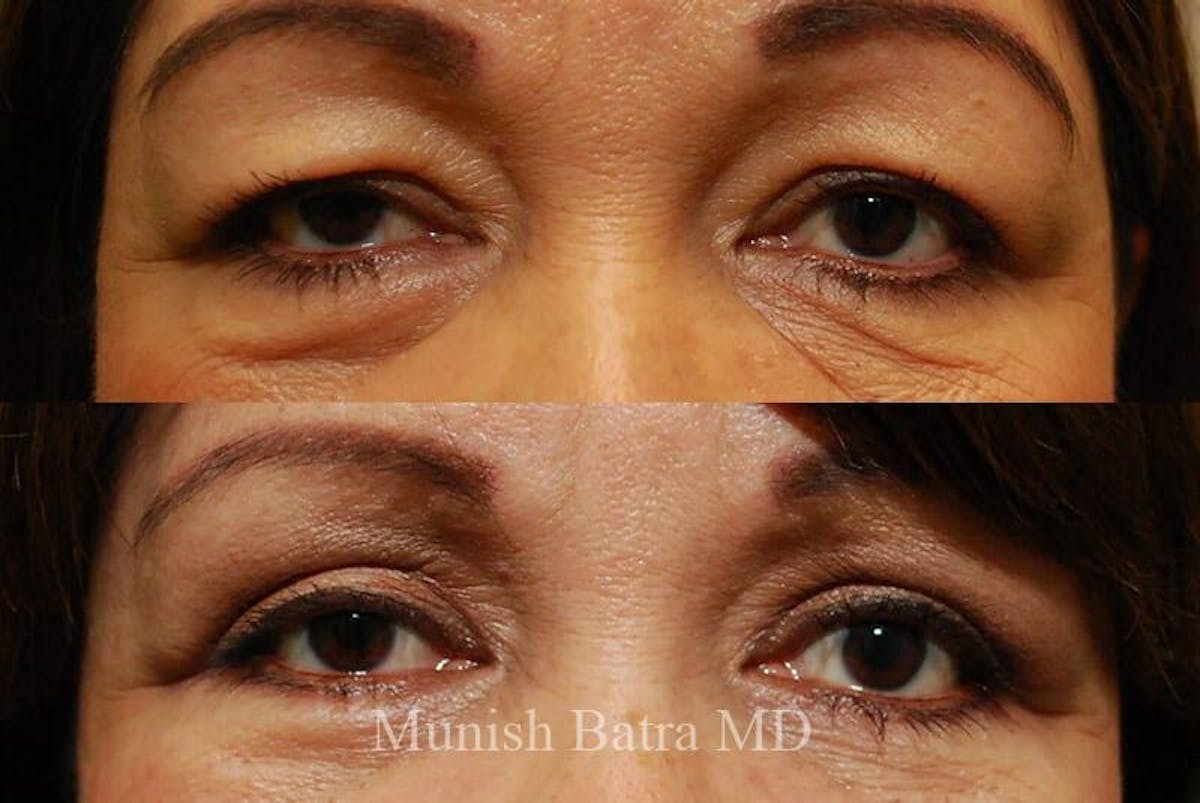 Eyelid Surgery and Brow Lift Before & After Gallery - Patient 131217 - Image 1