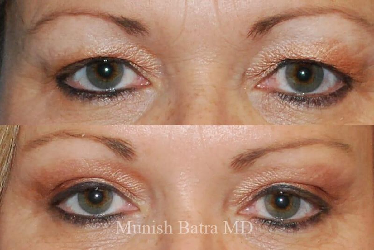 Eyelid Surgery and Brow Lift Before & After Gallery - Patient 366615 - Image 1