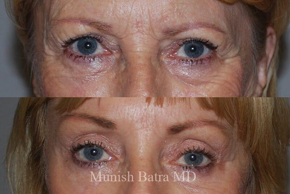 Eyelid Surgery and Brow Lift Before & After Gallery - Patient 759425 - Image 1