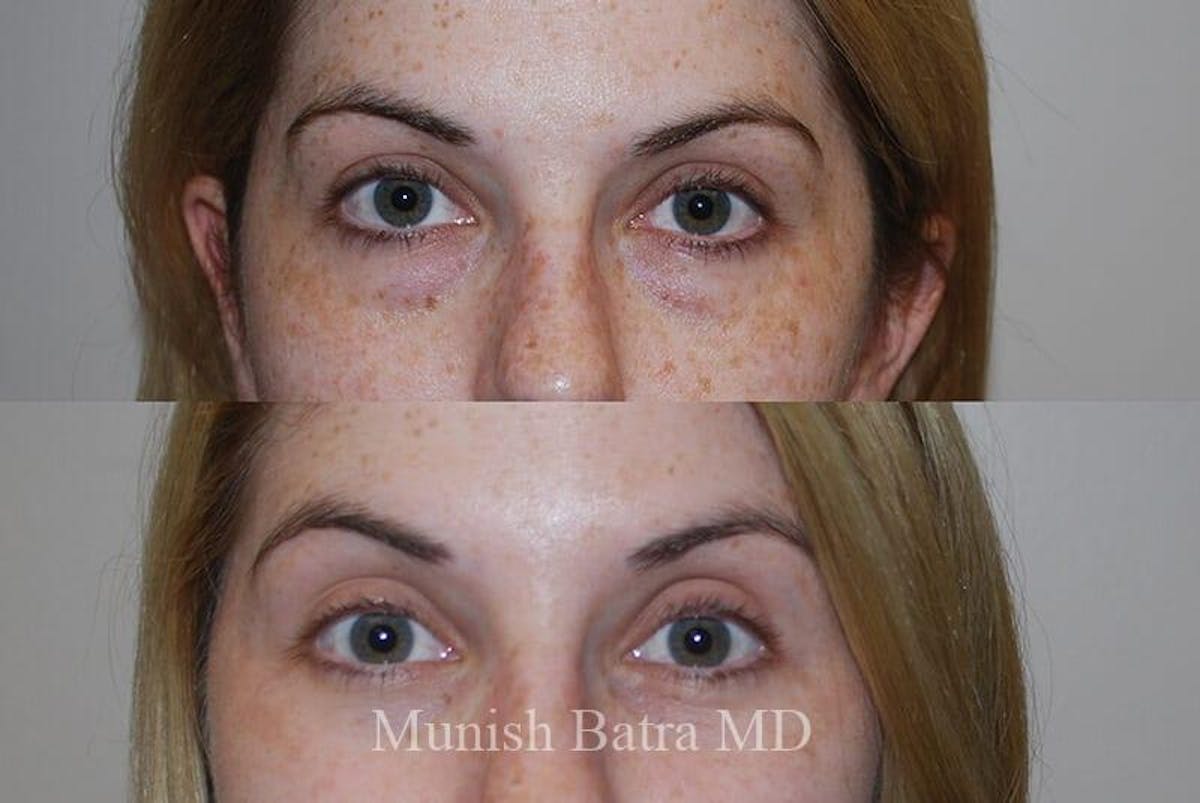 Eyelid Surgery and Brow Lift Before & After Gallery - Patient 580019 - Image 1