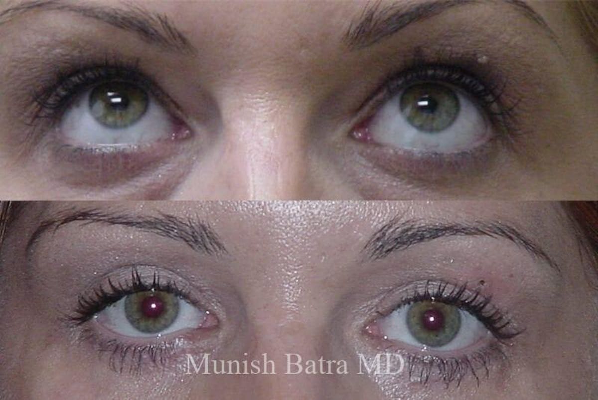 Eyelid Surgery and Brow Lift Before & After Gallery - Patient 384453 - Image 1