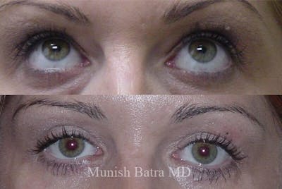 Eyelid Surgery and Brow Lift Before & After Gallery - Patient 384453 - Image 1