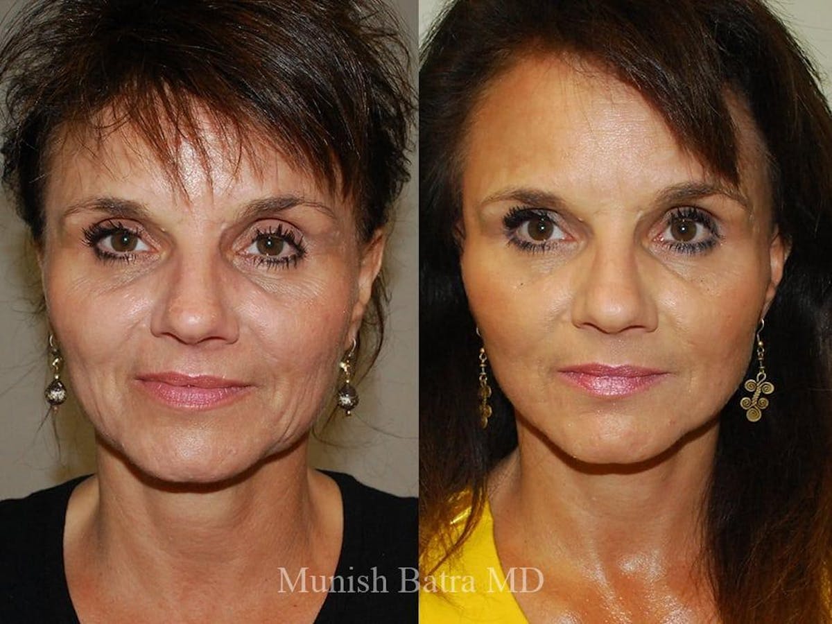 Facelift Before & After Gallery - Patient 123613 - Image 1