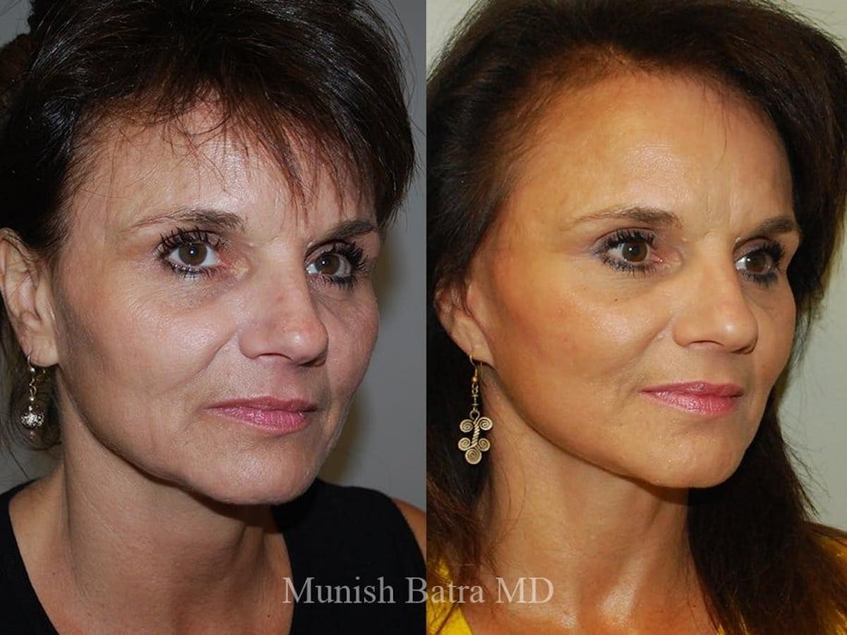 Facelift Before & After Gallery - Patient 123613 - Image 2