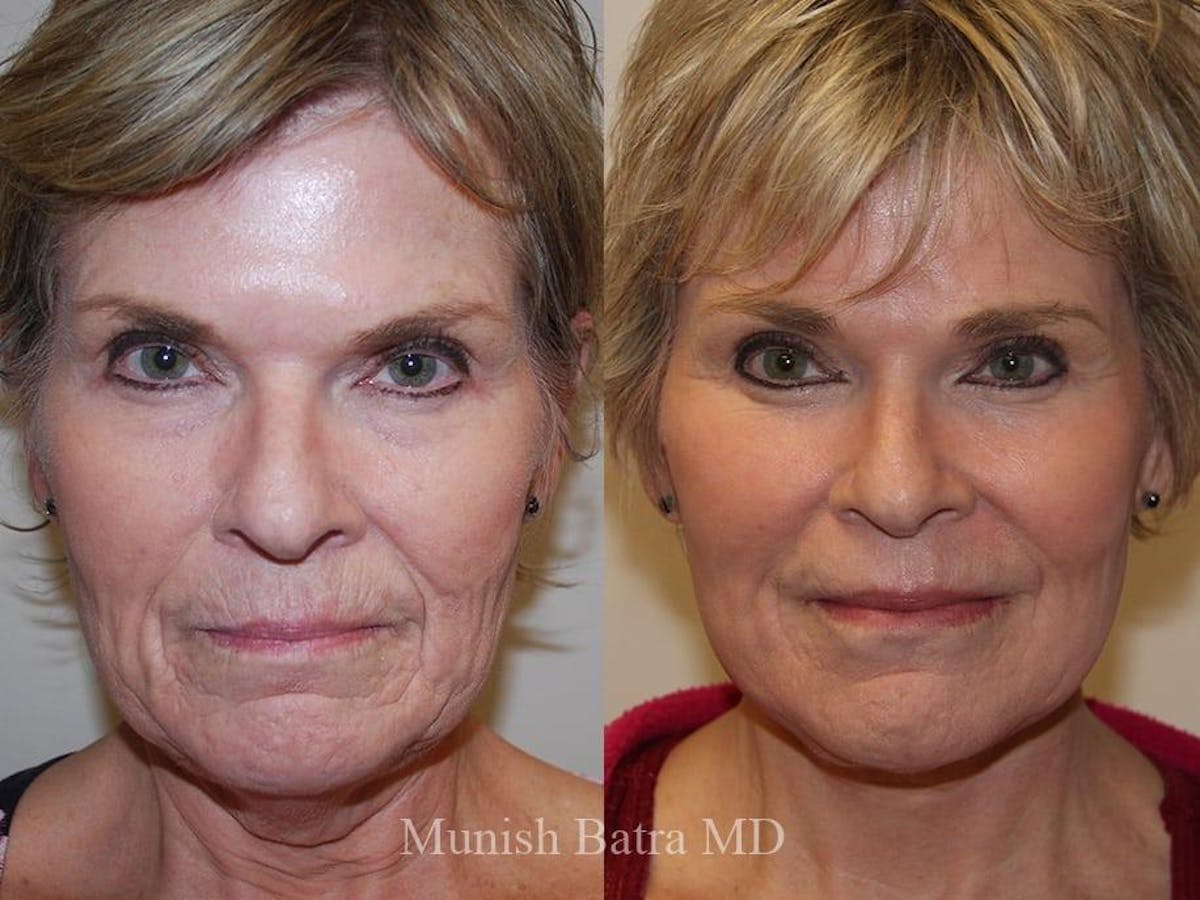 Facelift Before & After Gallery - Patient 195228 - Image 1