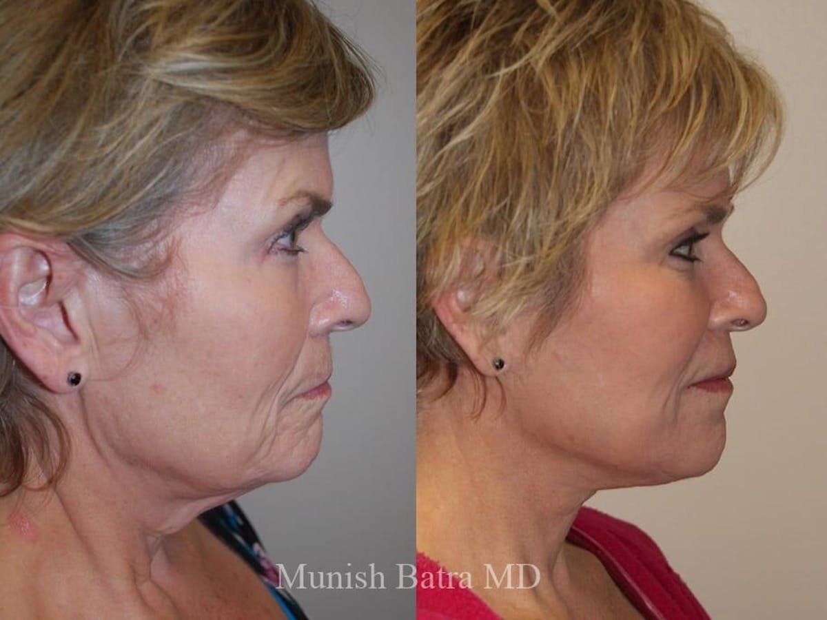 Facelift Before & After Gallery - Patient 195228 - Image 2