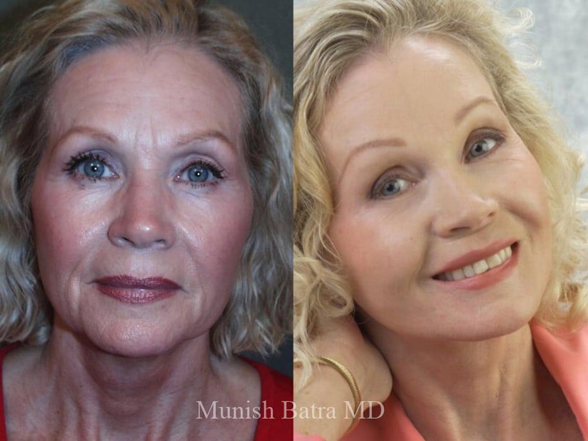 Facelift Before & After Gallery - Patient 371016 - Image 1