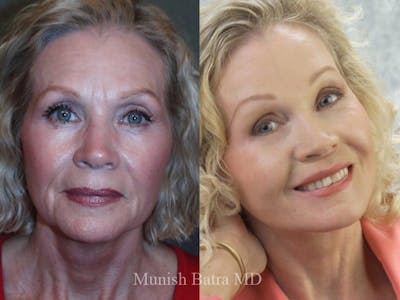 Facelift Before & After Gallery - Patient 371016 - Image 1