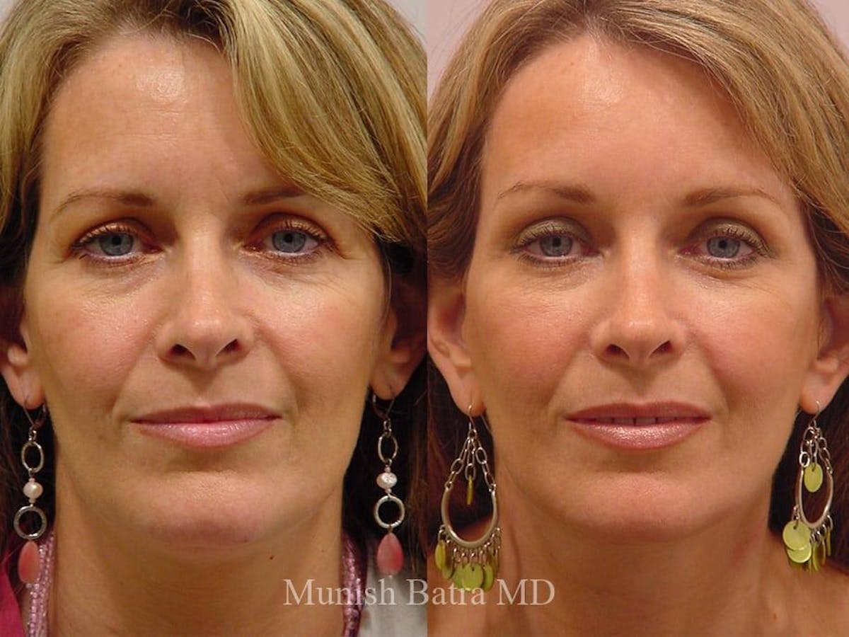 Facelift Before & After Gallery - Patient 117292 - Image 1