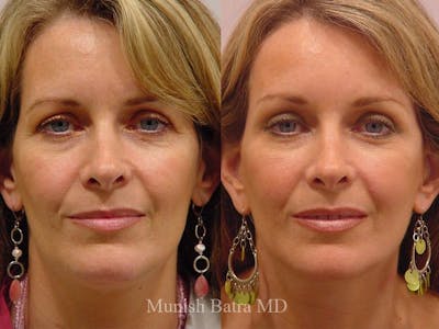 Facelift Before & After Gallery - Patient 117292 - Image 1