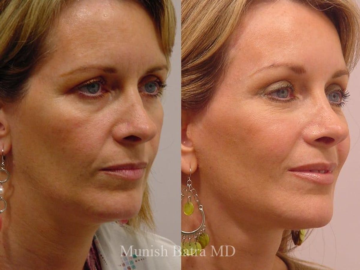 Facelift Before & After Gallery - Patient 117292 - Image 2