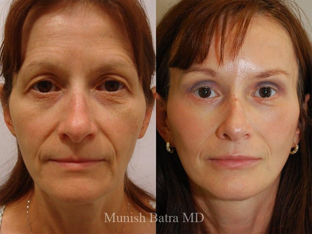 Facelift Before & After Gallery - Patient 251743 - Image 1
