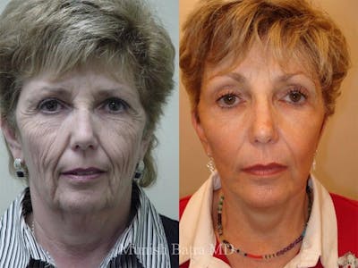 Facelift Before & After Gallery - Patient 110995 - Image 1