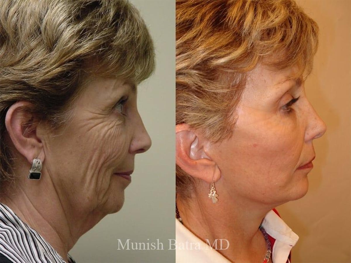Facelift Before & After Gallery - Patient 110995 - Image 2