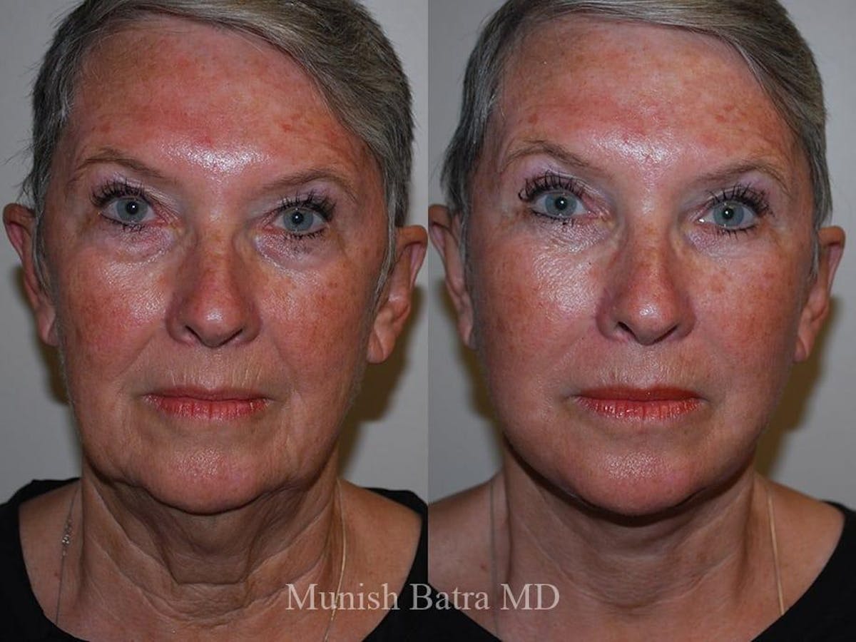 Facelift Before & After Gallery - Patient 892901 - Image 1