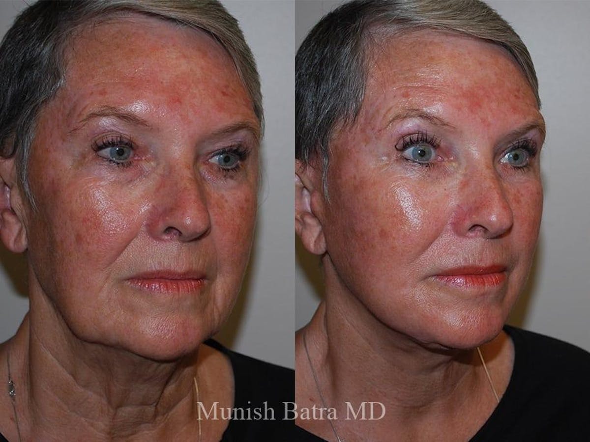 Facelift Before & After Gallery - Patient 892901 - Image 2