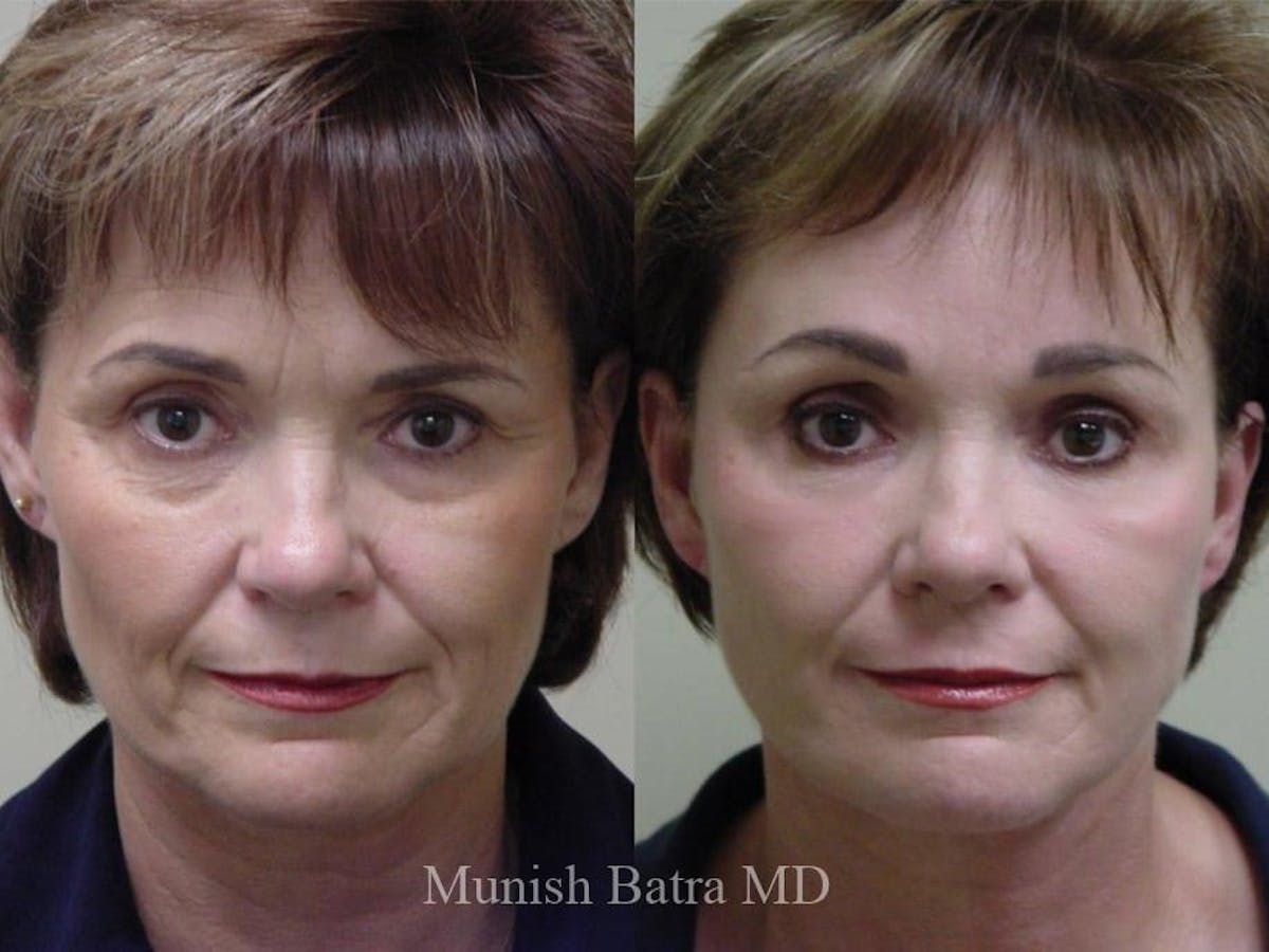Facelift Before & After Gallery - Patient 205479 - Image 1